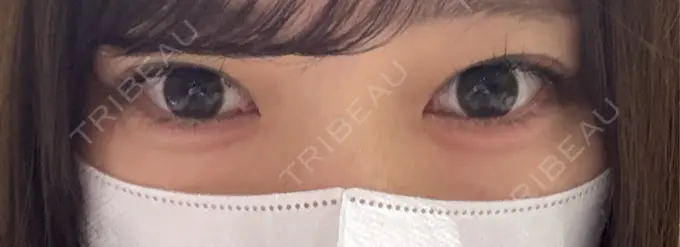 ヒアルロン酸注入（涙袋） フィラークリニック 名古屋栄院 DAY 0 メイン用