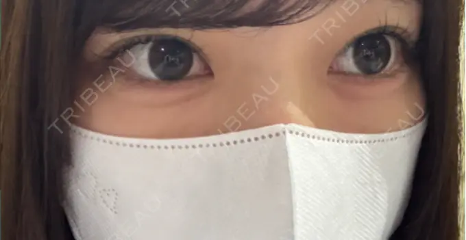 ヒアルロン酸注入（涙袋） フィラークリニック 名古屋栄院 DAY 0 メイン用