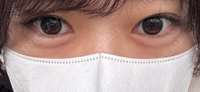 ヒアルロン酸注入（涙袋） フィラークリニック 名古屋栄院 AFTER メイン用