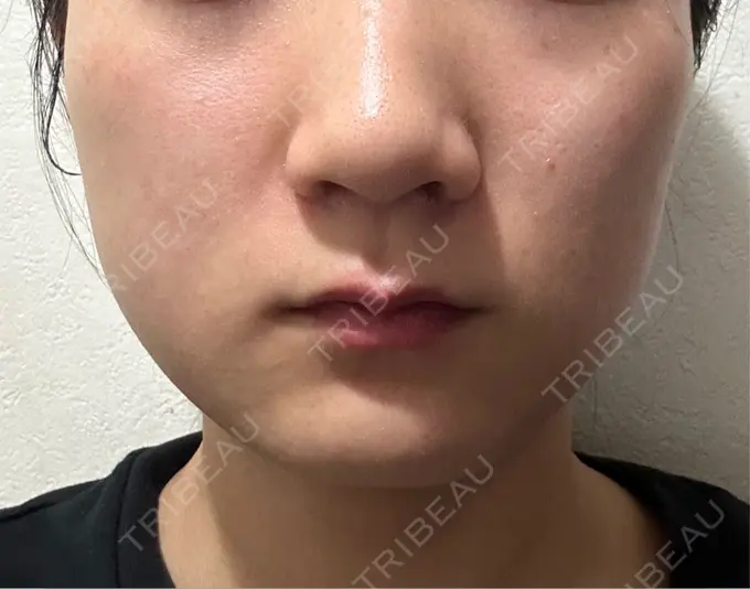 その他（輪郭） 横浜TAクリニック DAY 7 メイン用