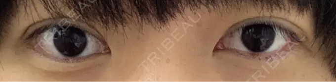 二重埋没 水の森美容クリニック 東京新宿院 DAY 5 メイン用