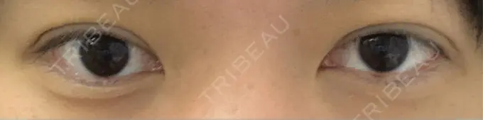 二重埋没 水の森美容クリニック 東京新宿院 AFTER メイン用