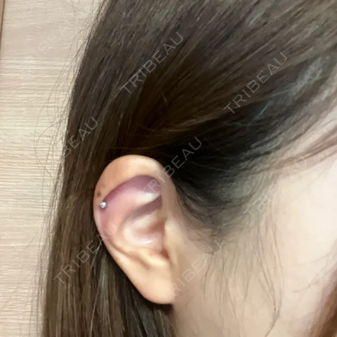 ピアス穴あけ 美容皮膚科エルムクリニック 神戸院 AFTER メイン用