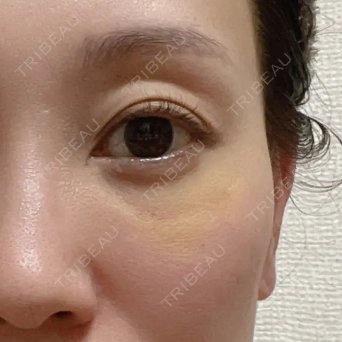 肌ヒアルロン酸注入（たるみ・シワ改善） しのぶ皮膚科 DAY 14 メイン用