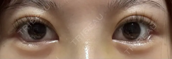 目尻切開 / タレ目形成・グラマラスライン（埋没） LOUIS CLINIC 二子玉川院【ルイクリニック】 DAY 1 メイン用