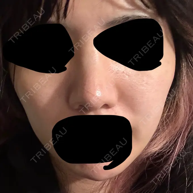 ヒアルロン酸注入（頬） THE FIRST CLINIC 町田院 AFTER メイン用