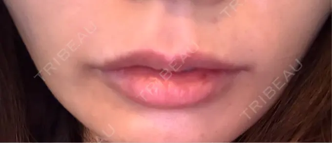 ヒアルロン酸注入（唇） / ヒアルロン酸注入（額） 目白ホワイトクリニック DAY 0 メイン用