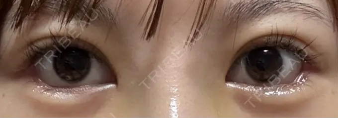 目尻切開 / タレ目形成・グラマラスライン（埋没） LOUIS CLINIC 二子玉川院【ルイクリニック】 DAY 2 メイン用