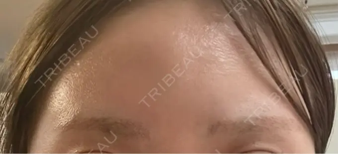 アートメイク除去・修正 ライズワン美容皮膚科クリニック AFTER メイン用