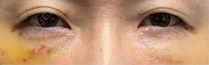 クマ治療 eクリニック 横浜みなとみらい院 DAY 7 メイン用