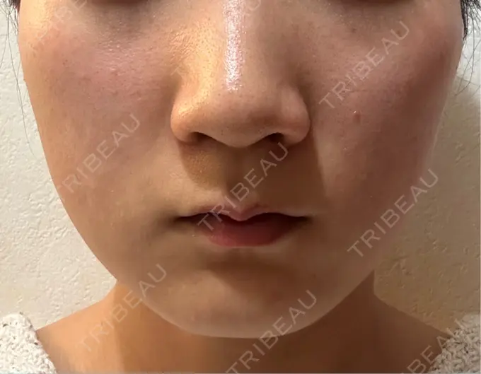 その他（輪郭） 横浜TAクリニック DAY 8 メイン用