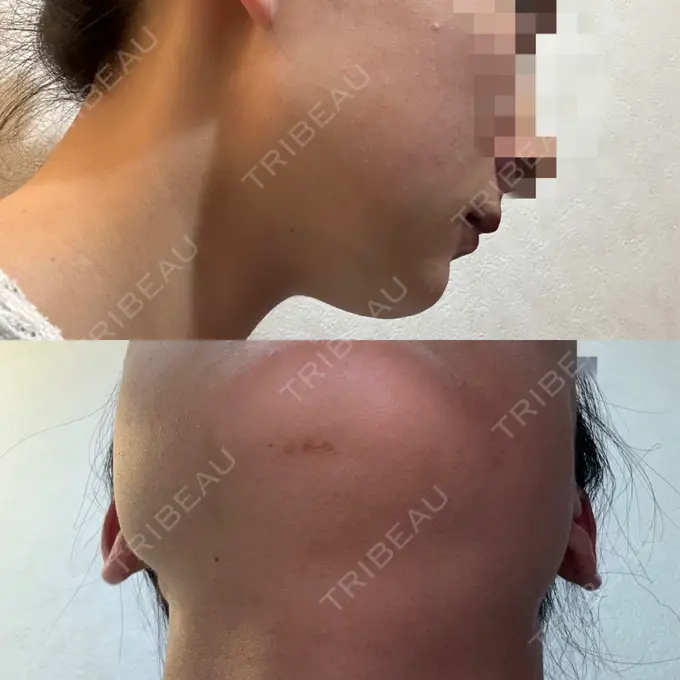 その他（輪郭） 横浜TAクリニック DAY 8 メイン用