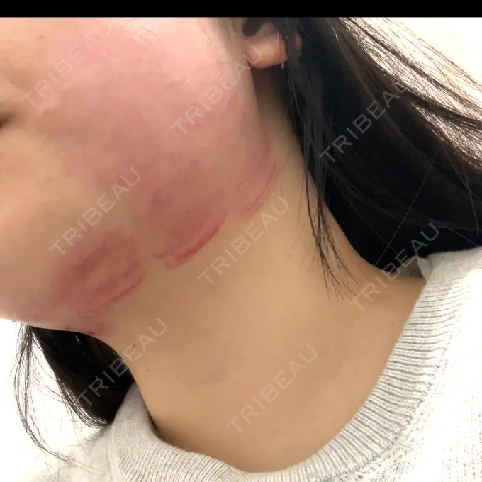 RF（高周波）たるみ治療 ゆきスキンクリニック 東池袋 DAY 0 メイン用