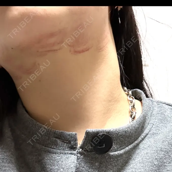 RF（高周波）たるみ治療 ゆきスキンクリニック 東池袋 DAY 0 メイン用