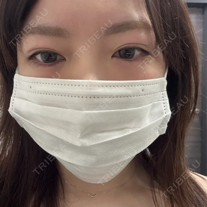 ヒアルロン酸注入（涙袋） / ヒアルロン酸注入（唇） 新未来クリニック AFTER メイン用