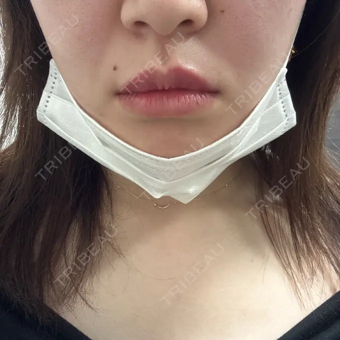 ヒアルロン酸注入（涙袋） / ヒアルロン酸注入（唇） 新未来クリニック DAY 0 メイン用