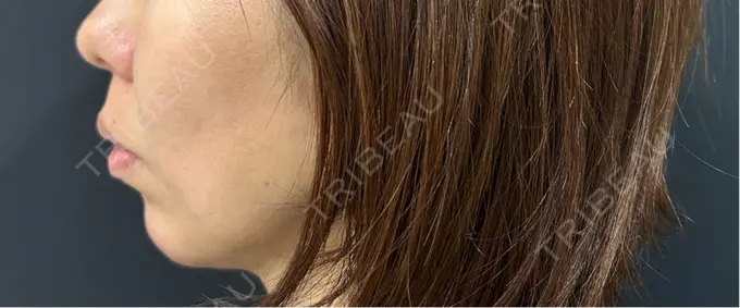 ボトックス（あご） / ヒアルロン酸注入（あご） / ヒアルロン酸注入（頬） HAAB BEAUTY CLINIC 名古屋院 DAY 0 メイン用