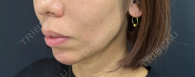 ボトックス（あご） / ヒアルロン酸注入（あご） / ヒアルロン酸注入（頬） HAAB BEAUTY CLINIC 名古屋院 DAY 0 メイン用