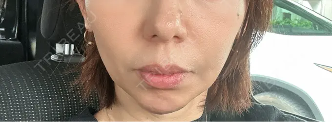 ボトックス（あご） / ヒアルロン酸注入（あご） / ヒアルロン酸注入（頬） HAAB BEAUTY CLINIC 名古屋院 DAY 1 メイン用