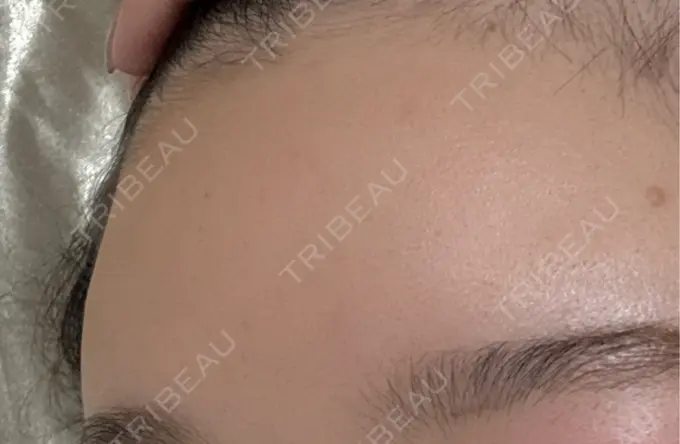 ヒアルロン酸注入（額） / ヒアルロン酸注入（こめかみ） Wi Clinic （ウィ クリニック）心斎橋院 AFTER メイン用