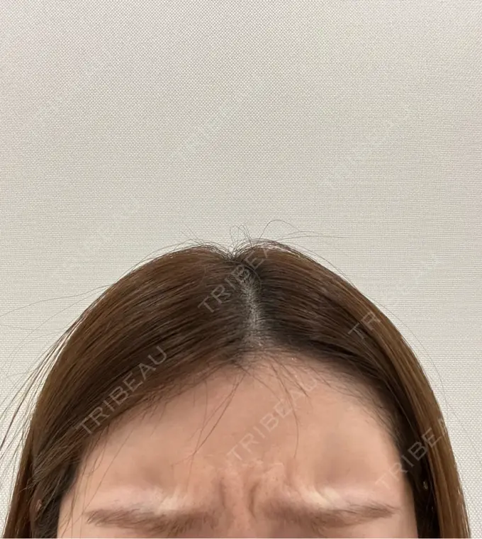 ボトックス（眉間） DAILY SKIN CLINIC 福岡院 AFTER メイン用