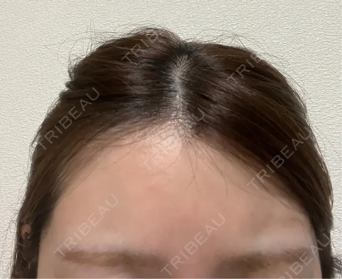 ボトックス（眉間） DAILY SKIN CLINIC 福岡院 DAY 2 メイン用