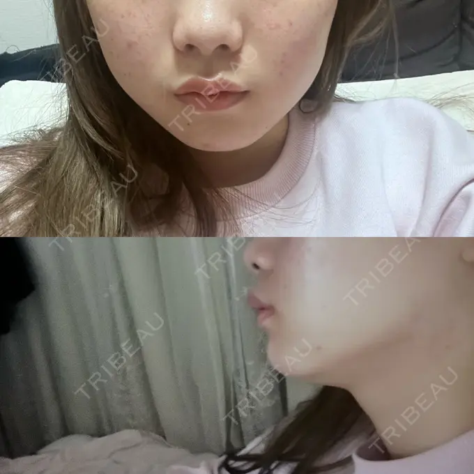 ボトックス（エラ・小顔） / インモード ルラ美容クリニック 町田院 DAY 0 メイン用