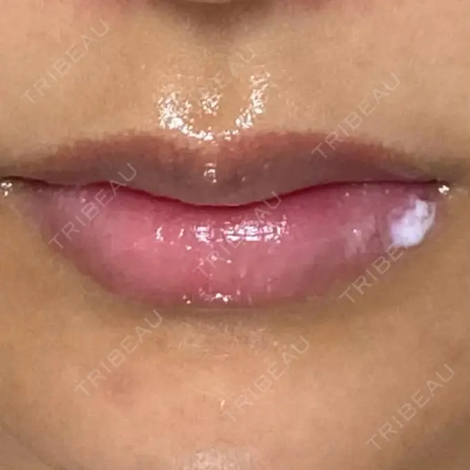 アートメイク（眉） / アートメイク（唇） Tokyo Tensei Clinic 新宿院 DAY 7 メイン用