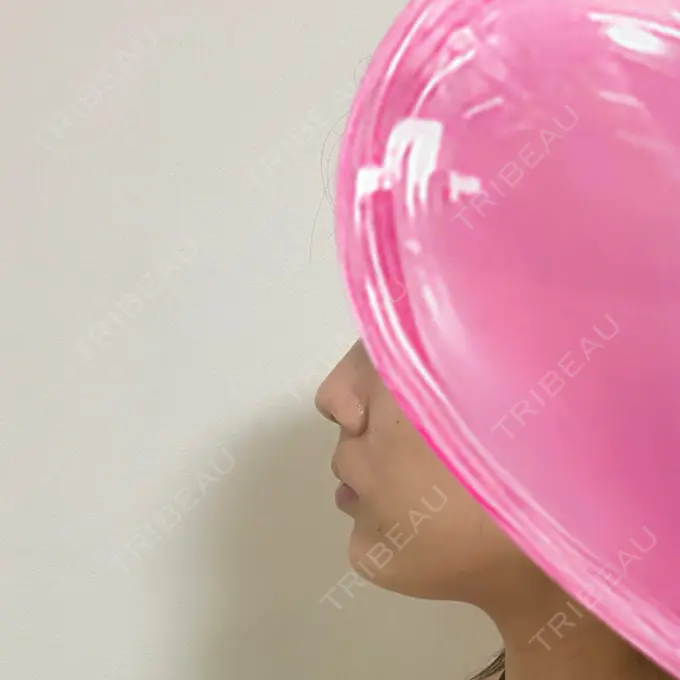 ボトックス（あご） / ヒアルロン酸注入（あご） HAAB×DREAM BEAUTY CLINIC 大阪梅田院 DAY 3 メイン用