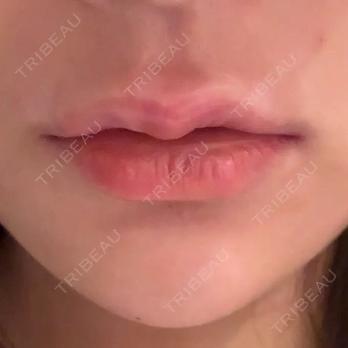 ヒアルロン酸注入（唇） 目白ホワイトクリニック AFTER メイン用