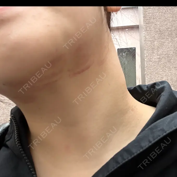 RF（高周波）たるみ治療 ゆきスキンクリニック 東池袋 DAY 2 メイン用