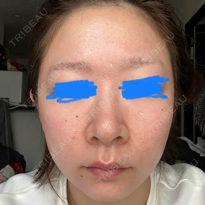 ピーリング（ハリ・ツヤ） / ルメッカ ルラ美容クリニック 名古屋栄院 / ルラスキンクリニック 名古屋栄院 DAY 1 メイン用