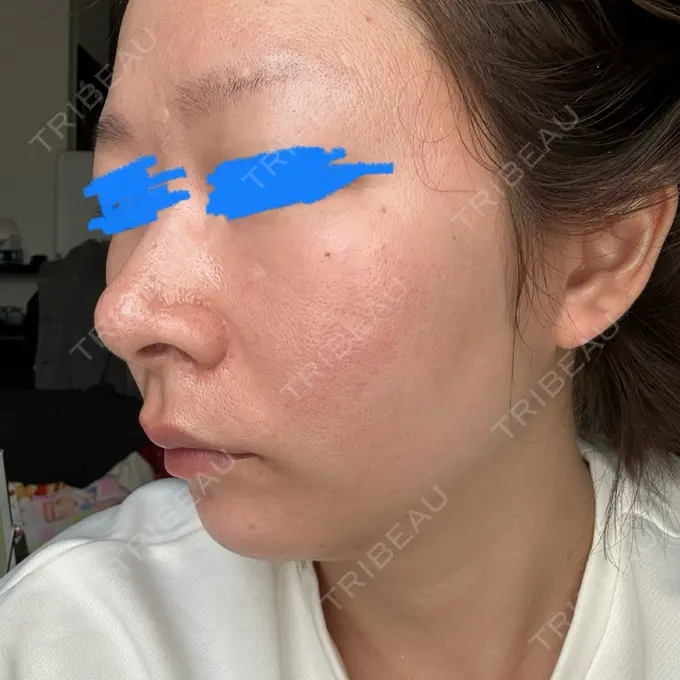 ピーリング（ハリ・ツヤ） / ルメッカ ルラ美容クリニック 名古屋栄院 / ルラスキンクリニック 名古屋栄院 DAY 1 メイン用