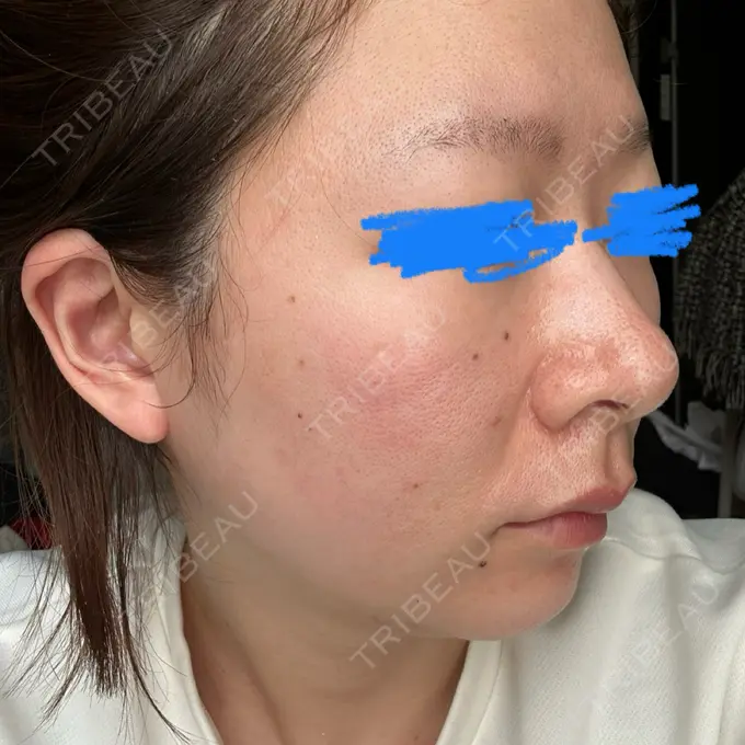 ピーリング（ハリ・ツヤ） / ルメッカ ルラ美容クリニック 名古屋栄院 / ルラスキンクリニック 名古屋栄院 DAY 1 メイン用