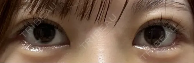 目尻切開 / タレ目形成・グラマラスライン（埋没） LOUIS CLINIC 二子玉川院【ルイクリニック】 DAY 3 メイン用