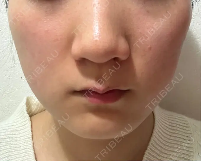 その他（輪郭） 横浜TAクリニック DAY 9 メイン用