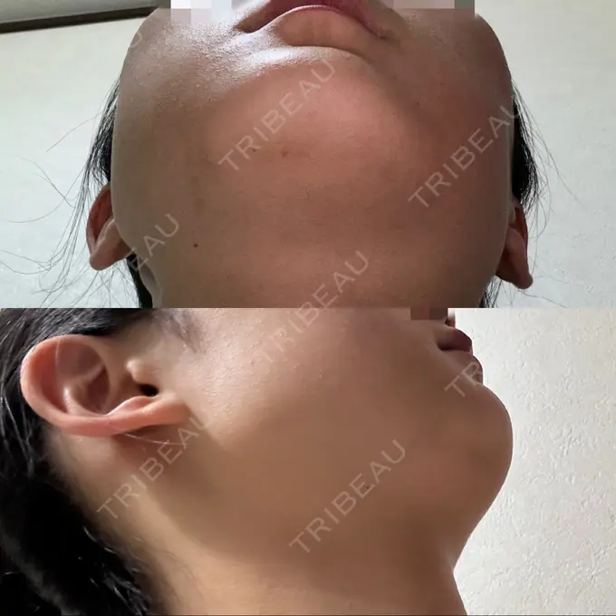 その他（輪郭） 横浜TAクリニック DAY 9 メイン用