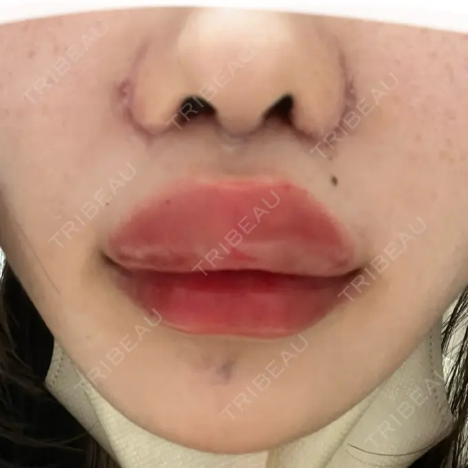 人中短縮 東京美容医療クリニック 池袋院 DAY 2 メイン用