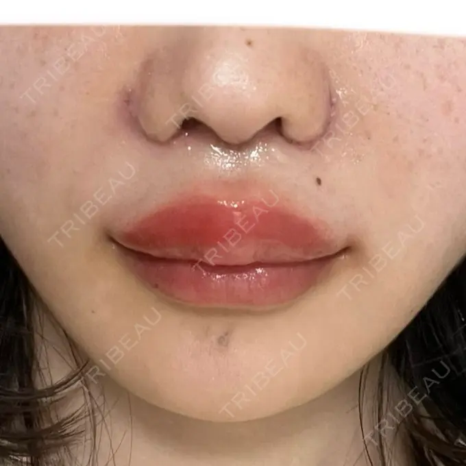 人中短縮 東京美容医療クリニック 池袋院 DAY 3 メイン用