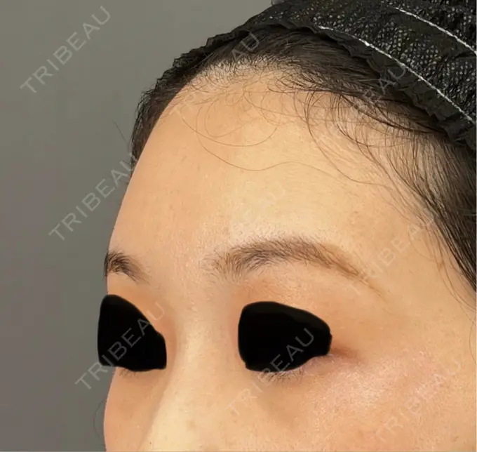 クマ治療 / 脂肪注入（額） / 脂肪吸引（腰） Casa de GRACIA GINZA 【カーサデグラシアギンザ】 AFTER メイン用