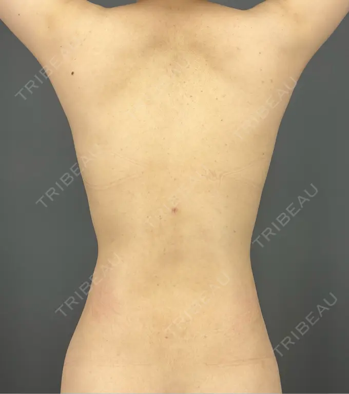 クマ治療 / 脂肪注入（額） / 脂肪吸引（腰） Casa de GRACIA GINZA 【カーサデグラシアギンザ】 DAY 29 メイン用