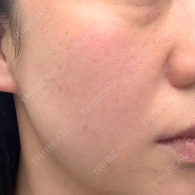 イオン導入 / 毛穴洗浄（ハイドラフェイシャルなど） / ルメッカ ルラ美容クリニック 仙台院 / ルラスキンクリニック 仙台院 DAY 0 メイン用