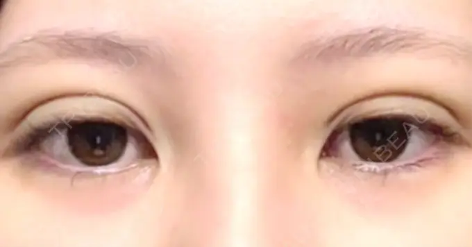 自然癒着法 eクリニック 福岡院 DAY 0 メイン用