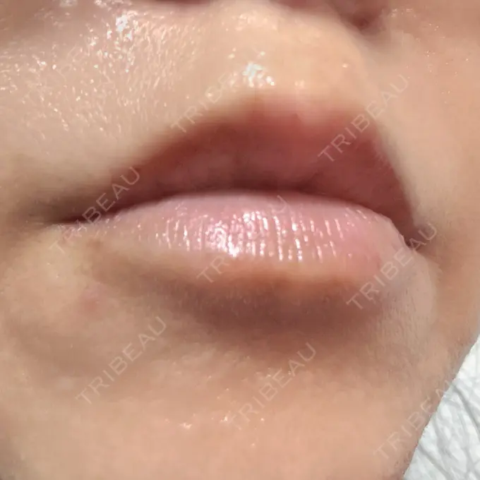 ヒアルロン酸注入（唇） 目白ホワイトクリニック DAY 3 メイン用