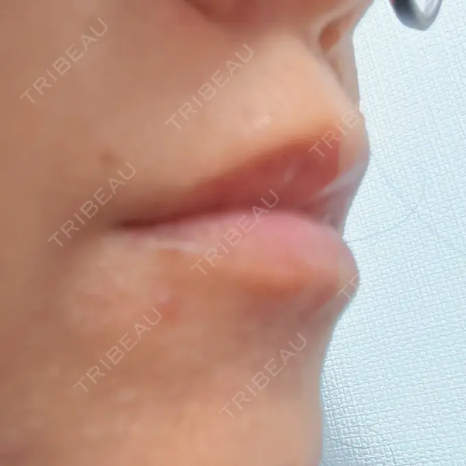 ヒアルロン酸注入（唇） 目白ホワイトクリニック DAY 3 メイン用