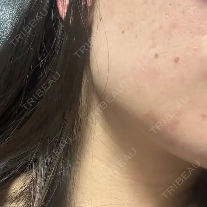 ボトックス（エラ・小顔） フィラークリニック 名古屋栄院 DAY 1 メイン用