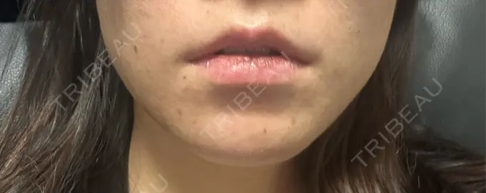 ボトックス（エラ・小顔） フィラークリニック 名古屋栄院 DAY 1 メイン用