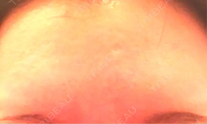 ボトックス（額） 湘南美容クリニック 名古屋栄院 DAY 1 メイン用