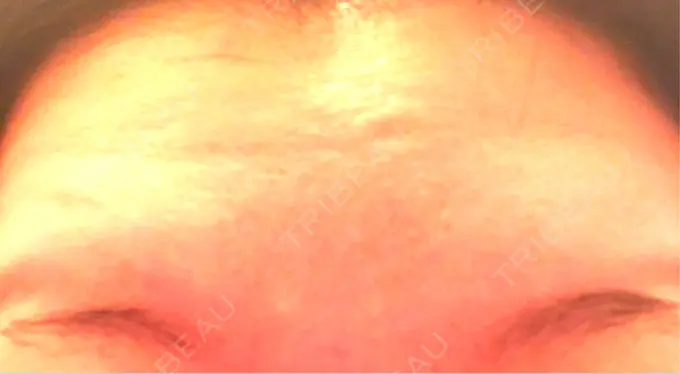 ボトックス（額） 湘南美容クリニック 名古屋栄院 DAY 2 メイン用