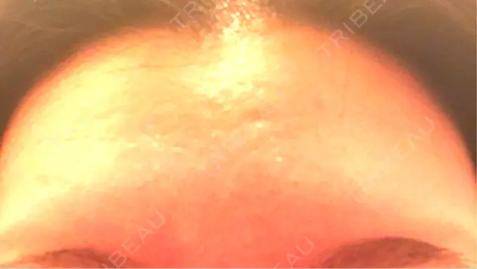 ボトックス（額） 湘南美容クリニック 名古屋栄院 DAY 5 メイン用